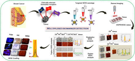 A clinically feasible diagnostic spectro-histology built on SERS-nanotags for multiplex detection and grading of breast cancer biomarkers